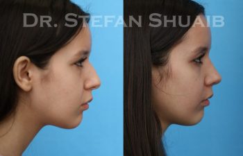 female patient before and after Rhinoplasty