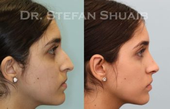 female patient before and after Rhinoplasty