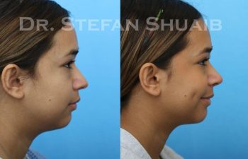 female patient before and after Rhinoplasty