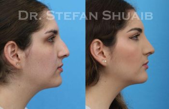 female patient before and after Rhinoplasty