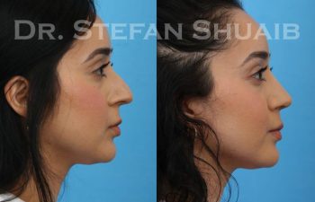 female patient before and after Rhinoplasty