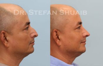 male patient before and after Rhinoplasty