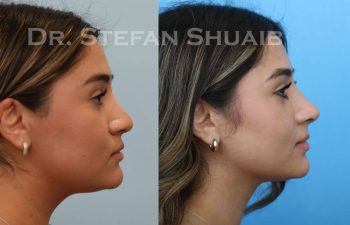 female patient before and after Rhinoplasty