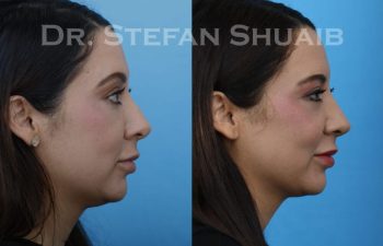 female patient before and after Rhinoplasty