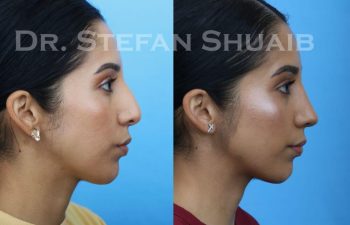 female patient before and after Rhinoplasty