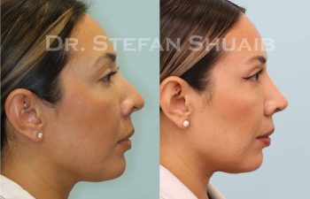 female patient before and after Rhinoplasty