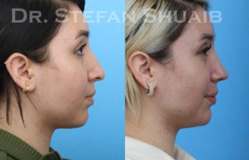 female patient before and after Rhinoplasty