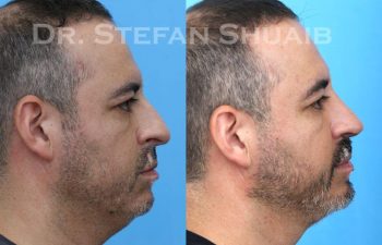 male patient before and after Rhinoplasty