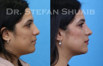 female patient before and after Rhinoplasty