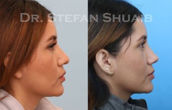 female patient before and after Rhinoplasty