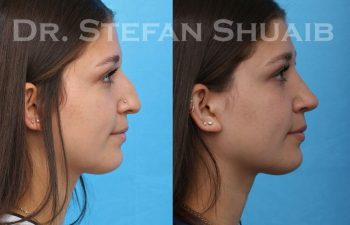 female patient before and after Rhinoplasty