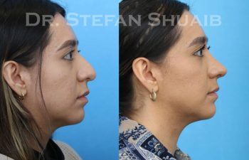 female patient before and after Rhinoplasty