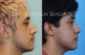 male patient before and after Rhinoplasty