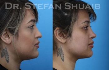 female patient before and after Rhinoplasty