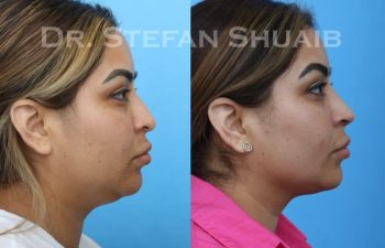 female patient before and after Rhinoplasty