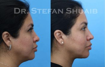 female patient before and after Facial Rejuvenation