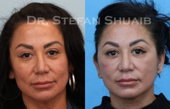 female patient before and after Facial Rejuvenation