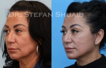 female patient before and after Facial Rejuvenation