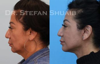 female patient before and after Facial Rejuvenation