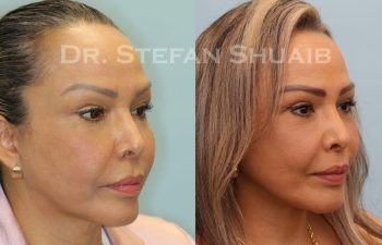 female patient before and after Facial Rejuvenation