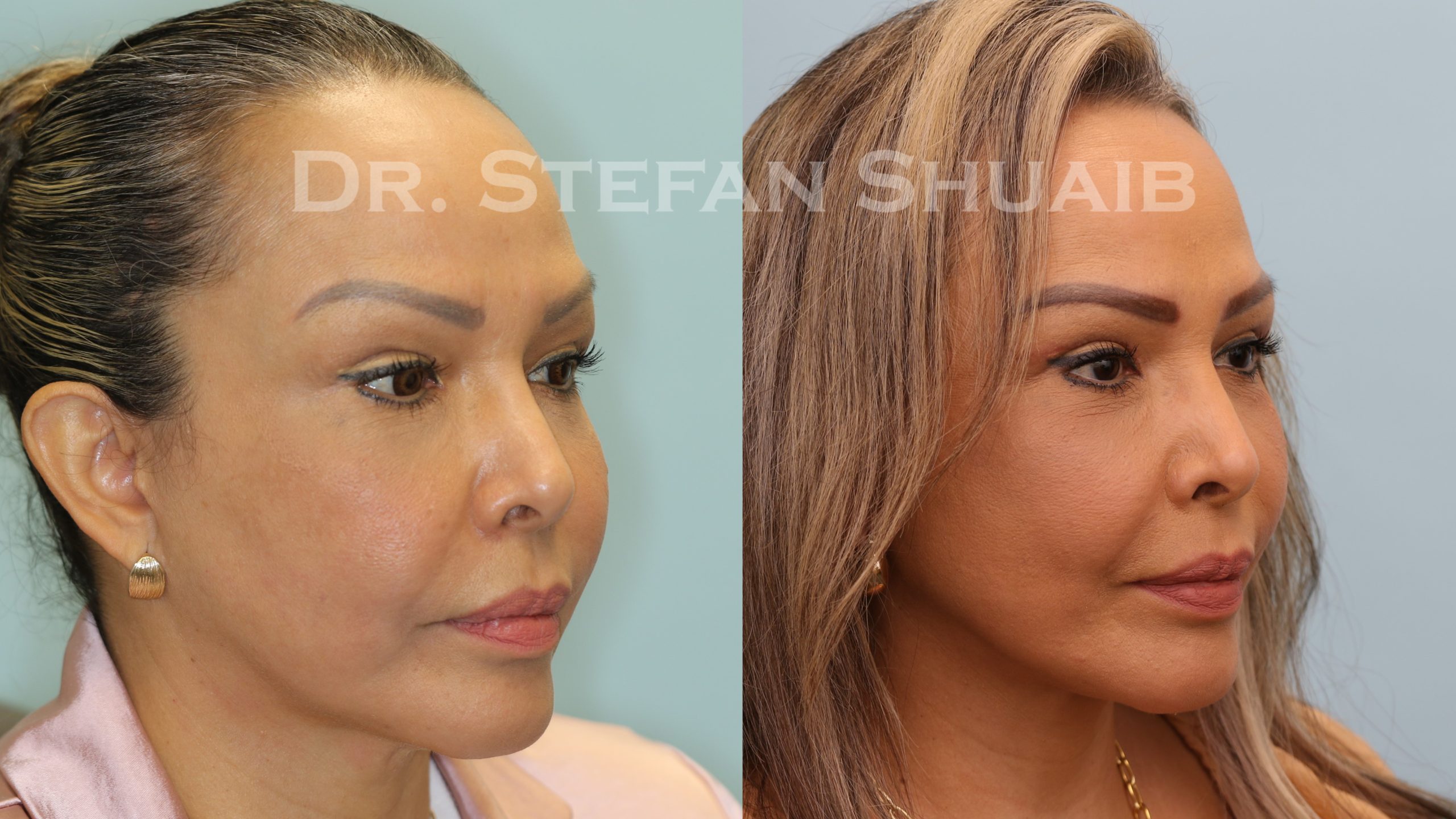 female patient before and after Facial Rejuvenation