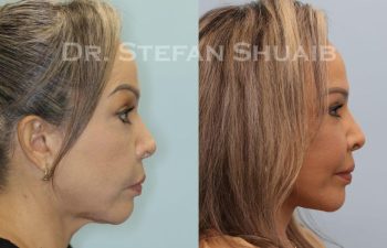 female patient before and after Facial Rejuvenation