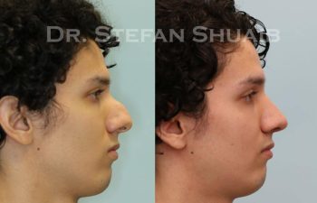 male patient before and after Rhinoplasty