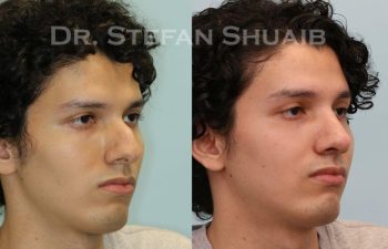 male patient before and after Rhinoplasty