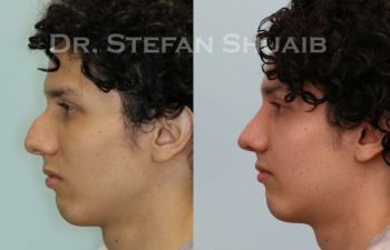 male patient before and after Rhinoplasty