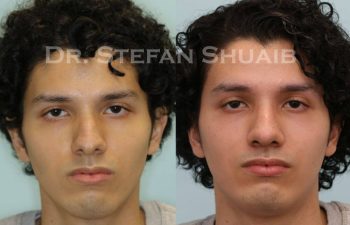 male patient before and after Rhinoplasty