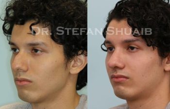 male patient before and after Rhinoplasty