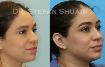 female patient before and after Rhinoplasty