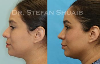 female patient before and after Rhinoplasty