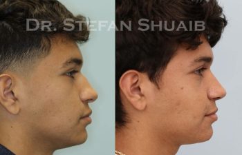 male patient before and after Rhinoplasty