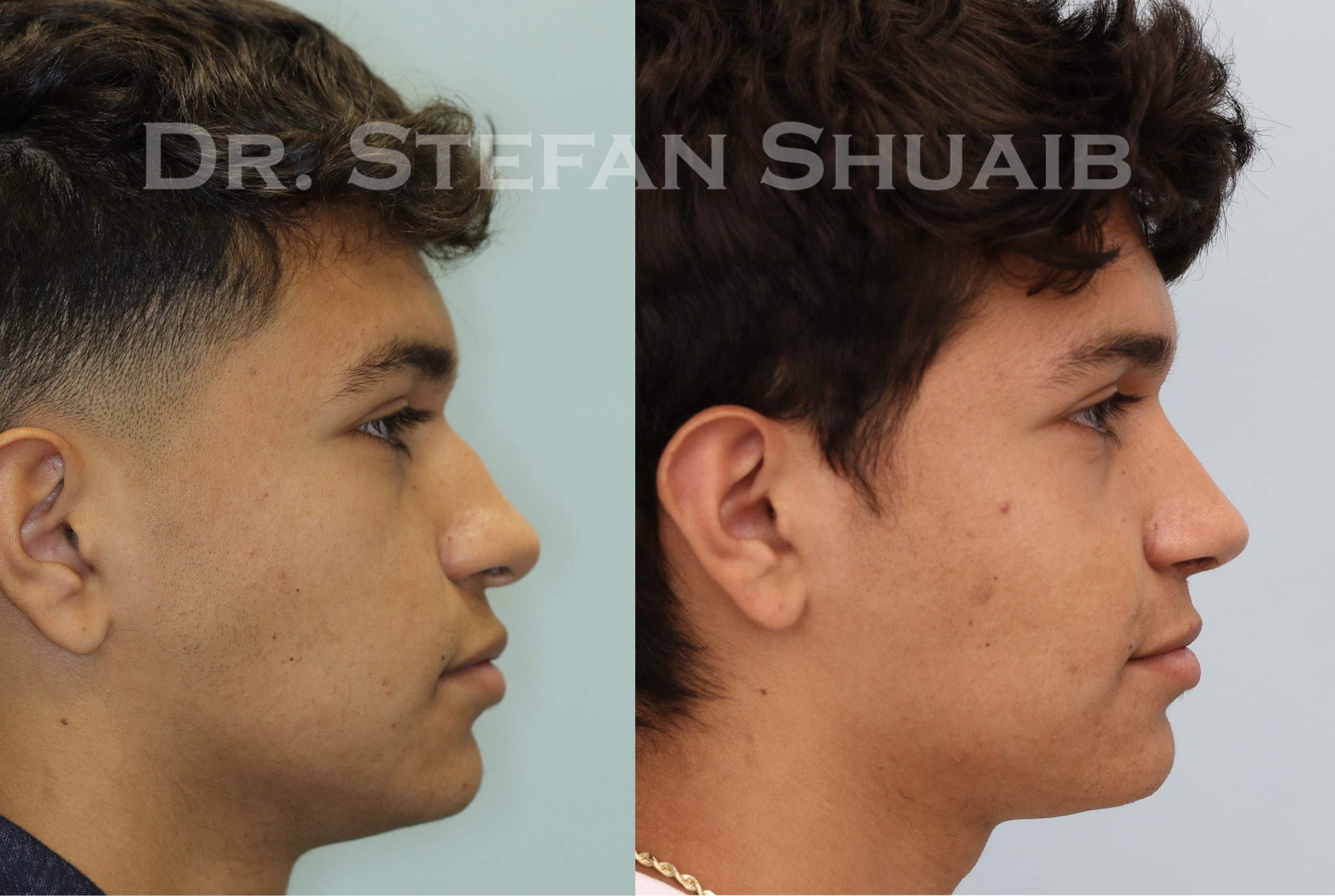 male patient before and after Rhinoplasty