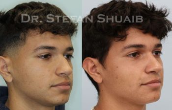 male patient before and after Rhinoplasty