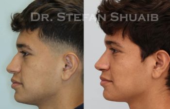 male patient before and after Rhinoplasty