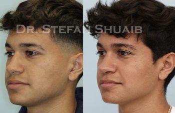 male patient before and after Rhinoplasty