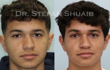 male patient before and after Rhinoplasty