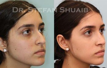 female patient before and after Rhinoplasty