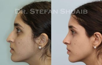 female patient before and after Rhinoplasty