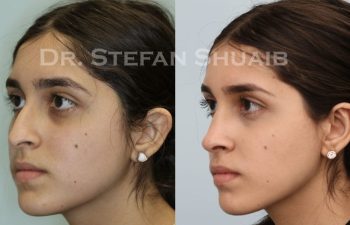 female patient before and after Rhinoplasty