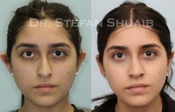 female patient before and after Rhinoplasty