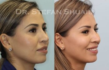 female patient before and after Rhinoplasty