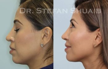 female patient before and after Rhinoplasty