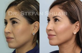 female patient before and after Rhinoplasty