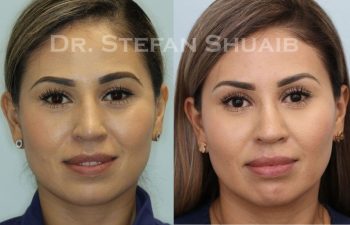 female patient before and after Rhinoplasty