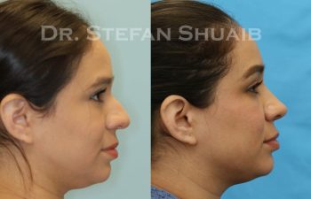 female patient before and after Rhinoplasty