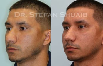 male patient before and after Rhinoplasty