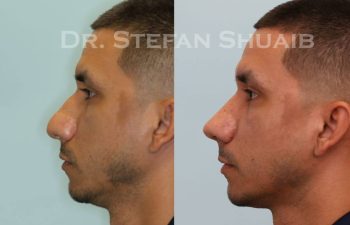 male patient before and after Rhinoplasty